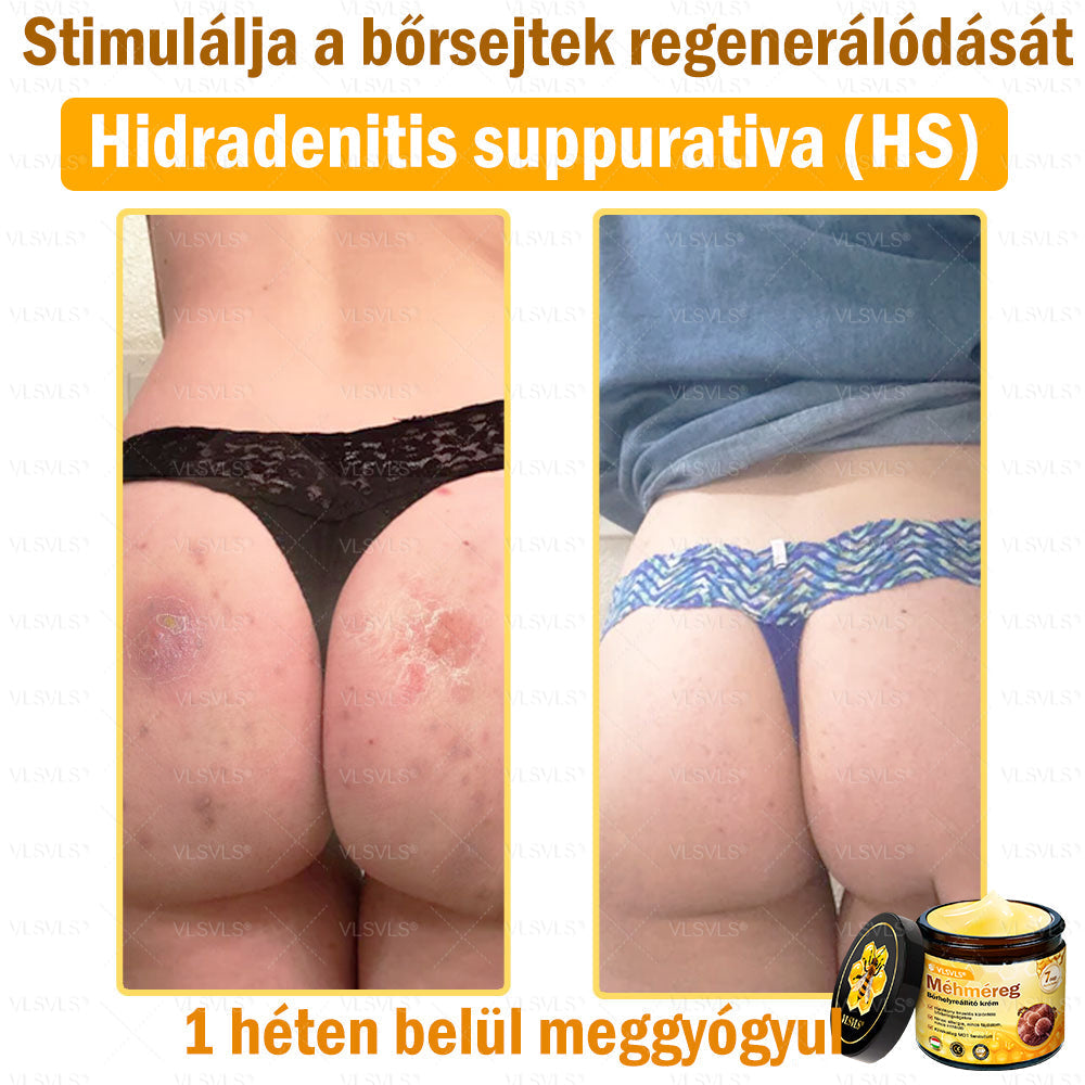 🔥🔥 𝑴é𝒉𝒎é𝒓𝒆𝒈 𝑩ő𝒓 𝑯𝒆𝒍𝒚𝒓𝒆á𝒍𝒍í𝒕ó 𝑲𝒓é𝒎 (👨‍⚕‍𝑪𝑬 𝑻𝒂𝒏ú𝒔í𝒕𝒗á𝒏𝒚) ✅ 𝐀 𝐛ö𝐫𝐩𝐫𝐨𝐛𝐥é𝐦á𝐤 𝐤𝐞𝐳𝐞𝐥é𝐬𝐞 𝐦𝐚𝐠á𝐛𝐚𝐧 𝐟𝐨𝐠𝐥𝐚𝐥𝐣𝐚: é𝐥𝐞𝐭𝐤𝐨𝐫𝐢 𝐟𝐨𝐥𝐭𝐨𝐤, 𝐡𝐞𝐠𝐞𝐤, 𝐬𝐳𝐞𝐦ö𝐥𝐜𝐬ö𝐤, 𝐛ö𝐫𝐧ö𝐯𝐞𝐝é𝐤𝐞𝐤, 𝐭á𝐥𝐲𝐨𝐠𝐨𝐤, 𝐩𝐚𝐭𝐭𝐚𝐧á𝐬𝐨𝐤, 𝐞𝐤𝐜é𝐦𝐚, 𝐩𝐬𝐨𝐫𝐢𝐚𝐬𝐢𝐬, 𝐚𝐜𝐧𝐞 𝐢𝐧𝐯𝐞𝐫𝐬𝐚, 𝐫á𝐧𝐜𝐨𝐤, 𝐛ö𝐫ö𝐫𝐞𝐠𝐞𝐝é𝐬 é𝐬 𝐞𝐠𝐲é𝐛 𝐩𝐫𝐨𝐛𝐥é𝐦á𝐤