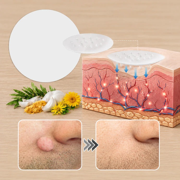 ✨HISKIN® 2 az 1-ben mikrotűs és hidrokolloid tapasz🍀 | Kiemelkedő anyajegyek, pattanások, lapos szemölcsök és bőrcimpák eltávolítására | Segít csökkenteni a ráncokat, hegeket és foltokat | Láthatatlan tapasz arcra és testre